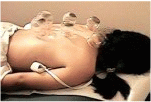cupping of Greensboro Acupuncturist Ning Li